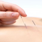 acupuncture-needles