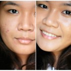 removing-acne-scar